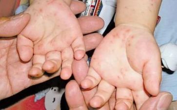 预防春季传染病讲话稿7篇